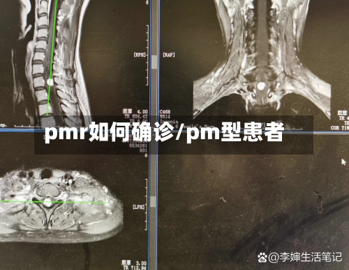 pmr如何确诊/pm型患者-第2张图片