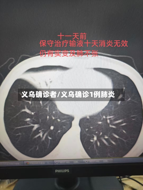 义乌确诊者/义乌确诊1例肺炎-第2张图片