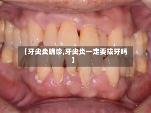 【牙尖炎确诊,牙尖炎一定要拔牙吗】