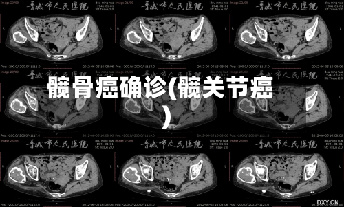 髋骨癌确诊(髋关节癌)