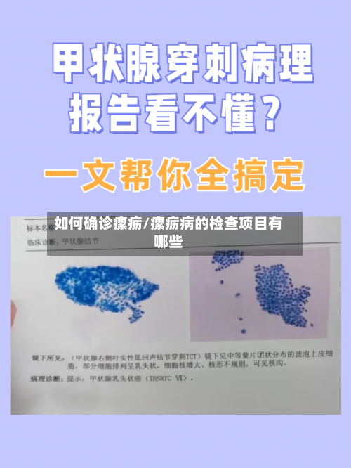 如何确诊瘰疬/瘰疬病的检查项目有哪些