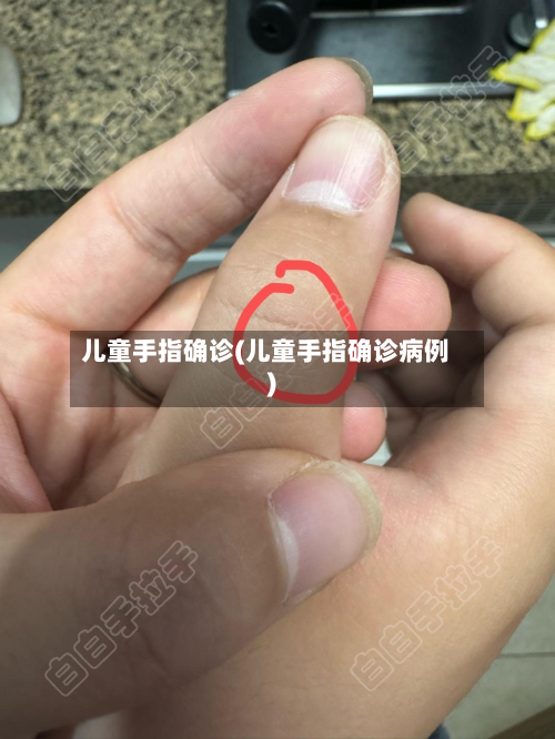 儿童手指确诊(儿童手指确诊病例)