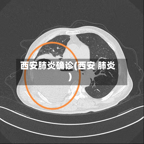 西安肺炎确诊(西安 肺炎)