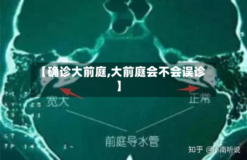 【确诊大前庭,大前庭会不会误诊】