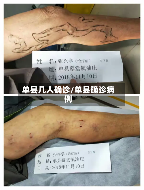 单县几人确诊/单县确诊病例-第2张图片