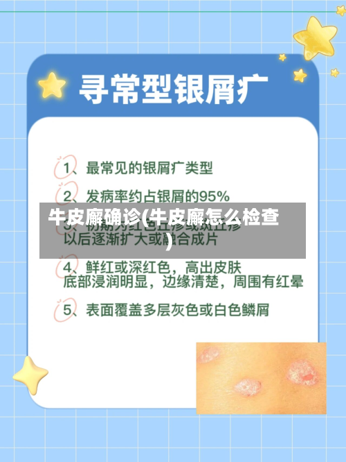 牛皮廨确诊(牛皮廨怎么检查)-第3张图片