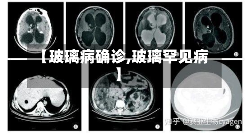 【玻璃病确诊,玻璃罕见病】