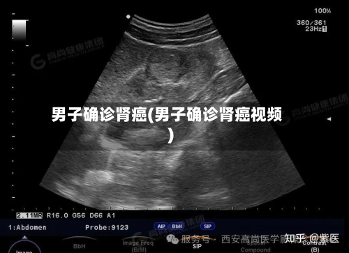 男子确诊肾癌(男子确诊肾癌视频)