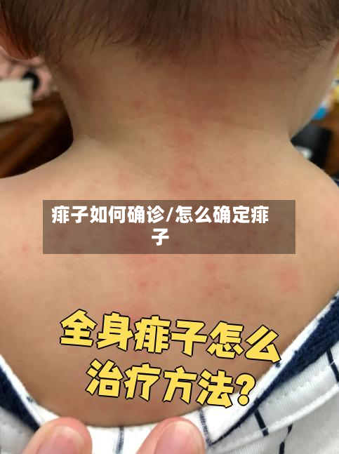 痱子如何确诊/怎么确定痱子