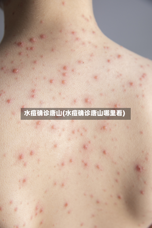 水痘确诊唐山(水痘确诊唐山哪里看)-第3张图片