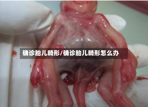确诊胎儿畸形/确诊胎儿畸形怎么办-第2张图片