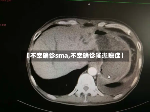 【不幸确诊sma,不幸确诊罹患癌症】-第2张图片