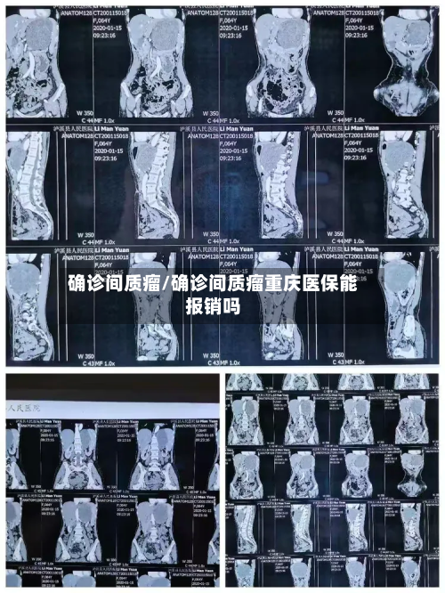 确诊间质瘤/确诊间质瘤重庆医保能报销吗