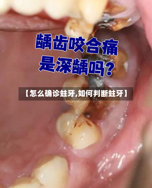 【怎么确诊蛀牙,如何判断蛀牙】-第2张图片