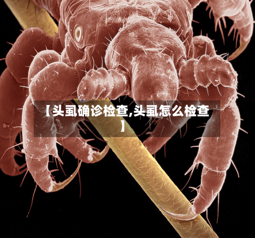 【头虱确诊检查,头虱怎么检查】