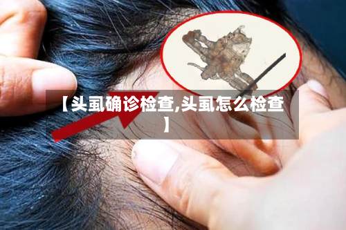 【头虱确诊检查,头虱怎么检查】-第2张图片