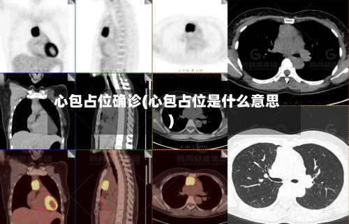 心包占位确诊(心包占位是什么意思)-第2张图片