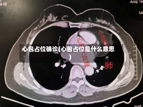 心包占位确诊(心包占位是什么意思)-第3张图片