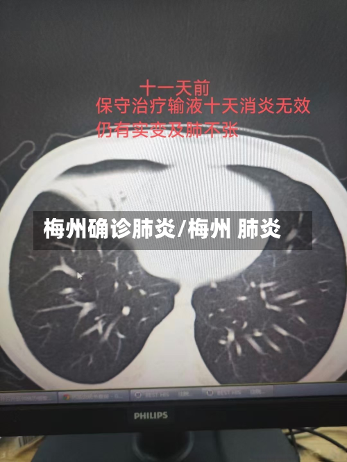 梅州确诊肺炎/梅州 肺炎