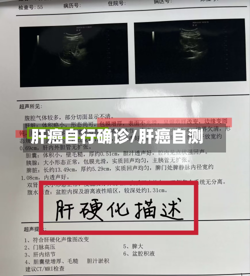 肝癌自行确诊/肝癌自测-第2张图片