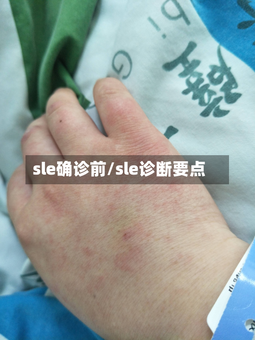sle确诊前/sle诊断要点