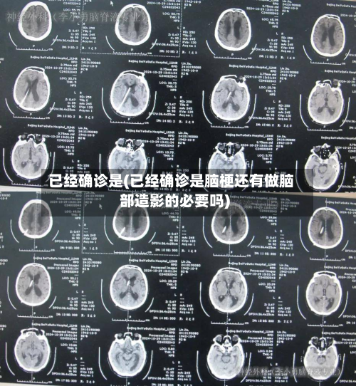 已经确诊是(已经确诊是脑梗还有做脑部造影的必要吗)-第2张图片