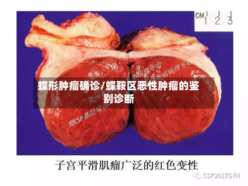 蝶形肿瘤确诊/蝶鞍区恶性肿瘤的鉴别诊断-第3张图片