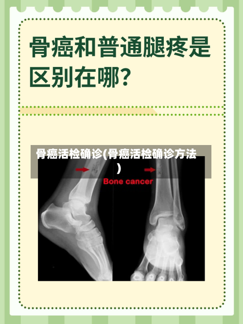 骨癌活检确诊(骨癌活检确诊方法)