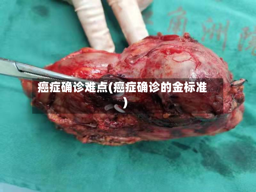 癌症确诊难点(癌症确诊的金标准)-第2张图片