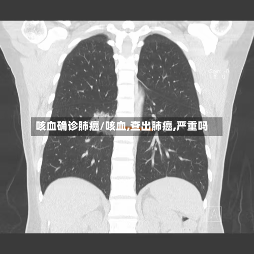 咳血确诊肺癌/咳血,查出肺癌,严重吗
