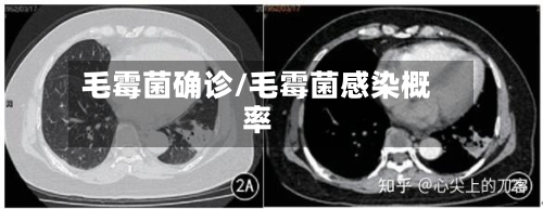 毛霉菌确诊/毛霉菌感染概率