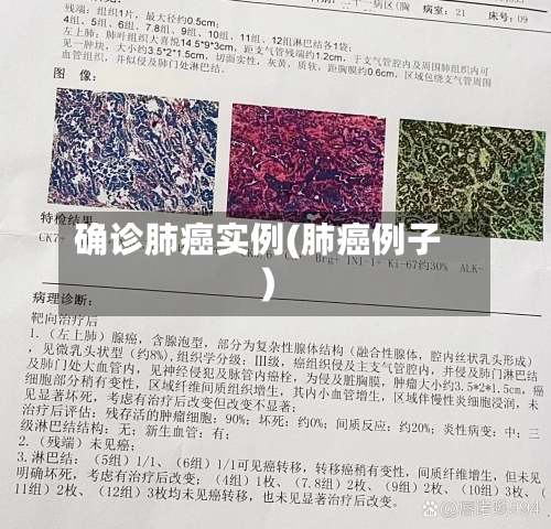 确诊肺癌实例(肺癌例子)-第3张图片