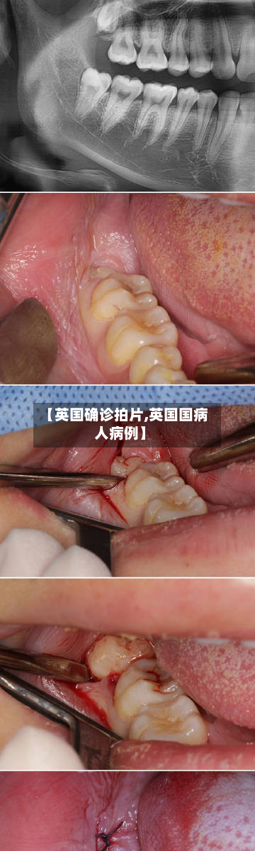【英国确诊拍片,英国国病人病例】-第2张图片