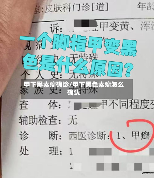 甲下黑素瘤确诊/甲下黑色素瘤怎么确认