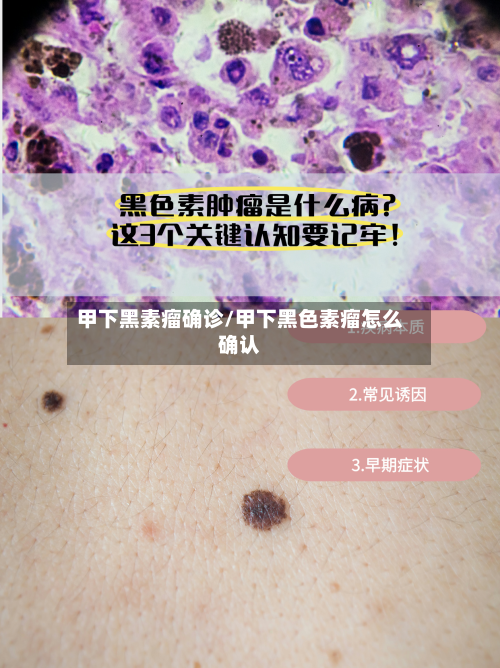 甲下黑素瘤确诊/甲下黑色素瘤怎么确认-第2张图片