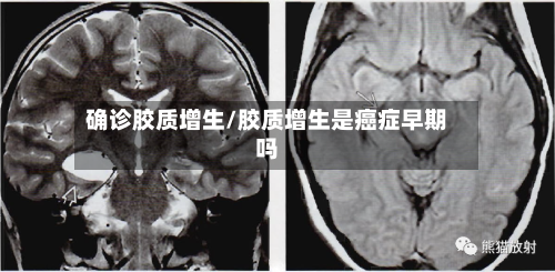 确诊胶质增生/胶质增生是癌症早期吗