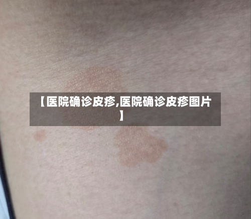 【医院确诊皮疹,医院确诊皮疹图片】-第3张图片