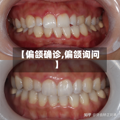 【偏颌确诊,偏颌询问】