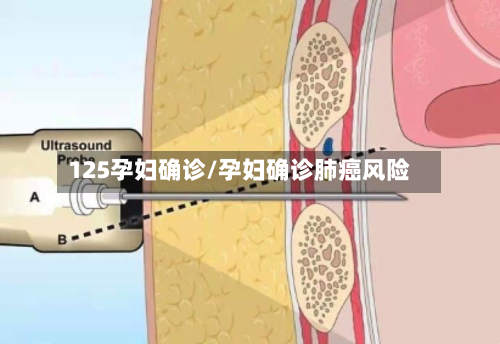 125孕妇确诊/孕妇确诊肺癌风险