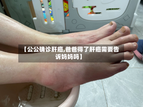 【公公确诊肝癌,爸爸得了肝癌需要告诉妈妈吗】