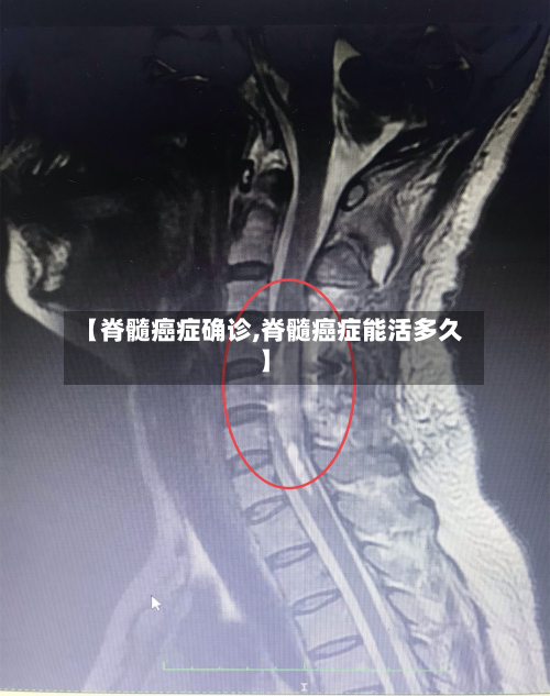 【脊髓癌症确诊,脊髓癌症能活多久】