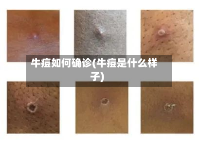 牛痘如何确诊(牛痘是什么样子)-第2张图片