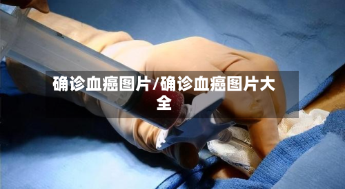确诊血癌图片/确诊血癌图片大全
