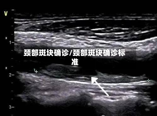颈部斑块确诊/颈部斑块确诊标准-第2张图片