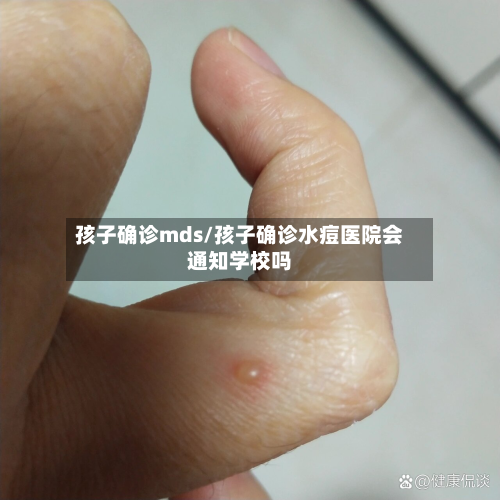孩子确诊mds/孩子确诊水痘医院会通知学校吗