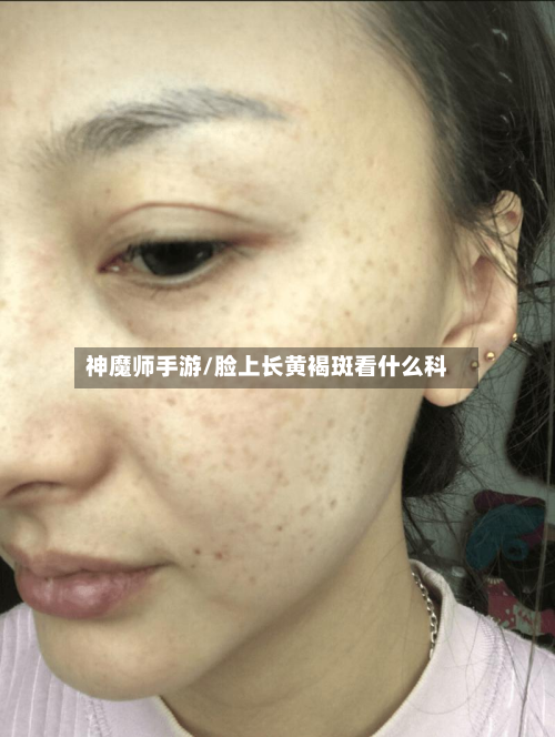 神魔师手游/脸上长黄褐斑看什么科