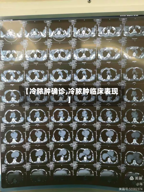 【冷脓肿确诊,冷脓肿临床表现】-第2张图片