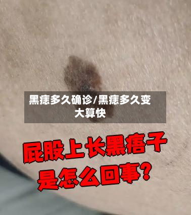 黑痣多久确诊/黑痣多久变大算快-第2张图片