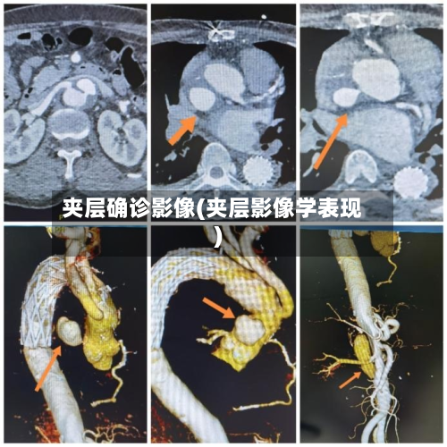 夹层确诊影像(夹层影像学表现)-第2张图片
