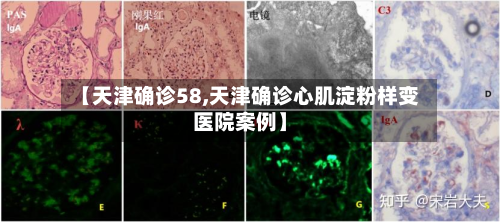 【天津确诊58,天津确诊心肌淀粉样变医院案例】-第2张图片